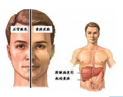 5月新款GK-5000型号中医体质辨识仪器诊断出眼黄、皮肤黄和肝有密不可分的联系